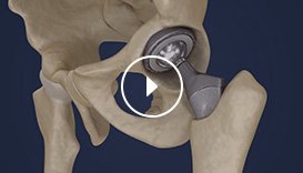 Methods of Entry for a Hip Replacement