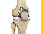 Knee Replacement