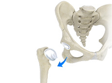 Hip Dislocation