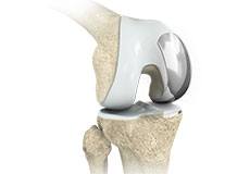 Unicompartmental/Partial Knee Replacement