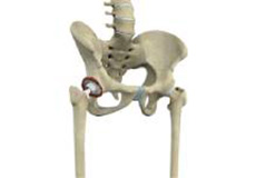 Revision Hip Replacement