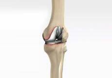 Revision Knee Replacement